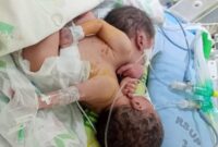 Ibu Yang Melahirkan Bayi Kembar Siam Ini Minta Perhatian Bupati Zahir
