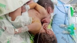 Ibu Yang Melahirkan Bayi Kembar Siam Ini Minta Perhatian Bupati Zahir